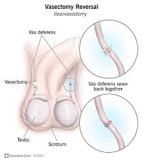 Victorian Insights: Vasectomy Reversal Success Stories